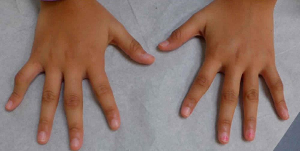 artritis
